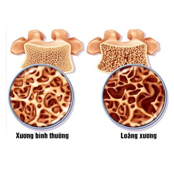 Loãng xương